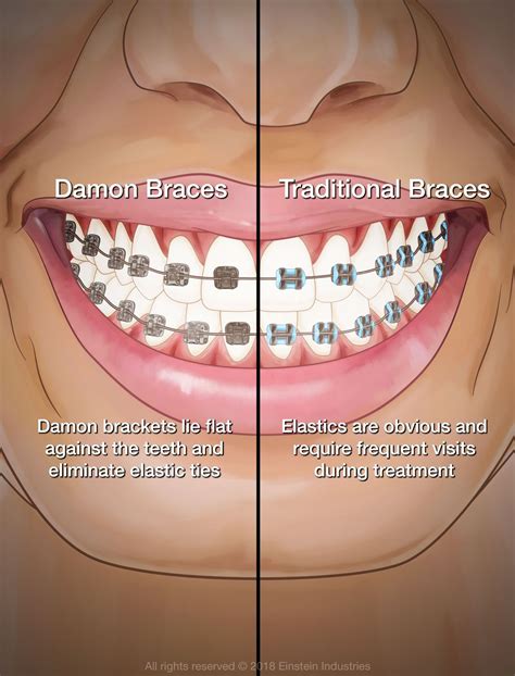 damon metal brackets|are damon braces more expensive.